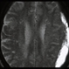 Subdural Hematoma, Brain Scan Subdural Hematoma, Brain Scan